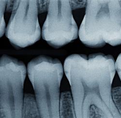 kleine kariöse Defekte sind im Röntgenbild zwischen den Zähnen zu erkennen 